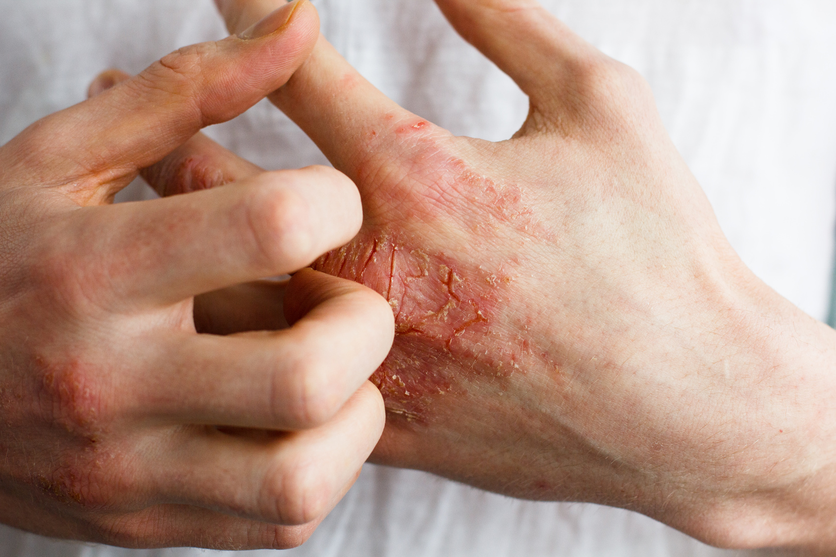 Eczema and how to find relief naturally!