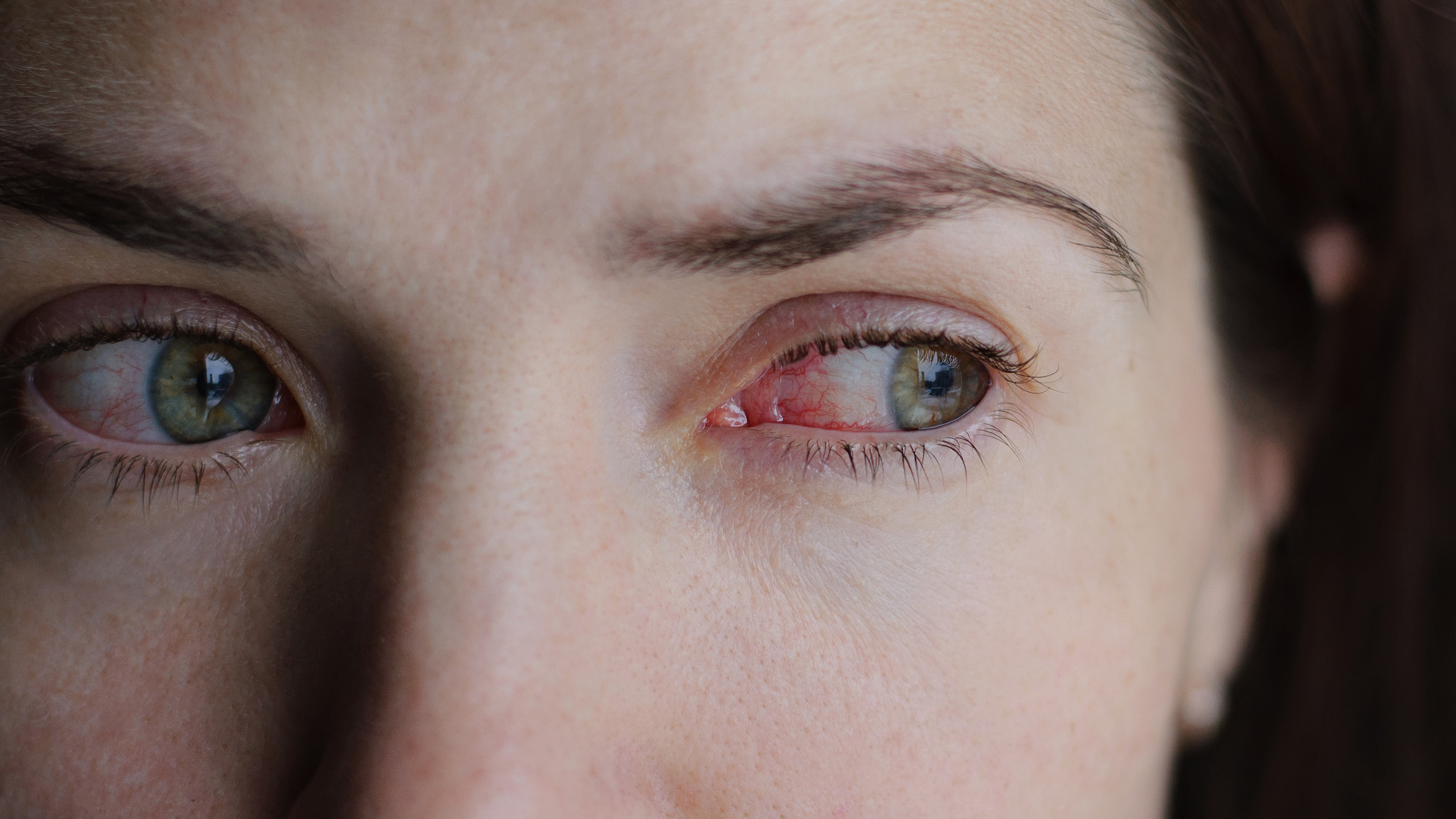 How to treat pink eye, naturally!